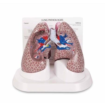 Nasco LUNG CANCER MODEL SB44894